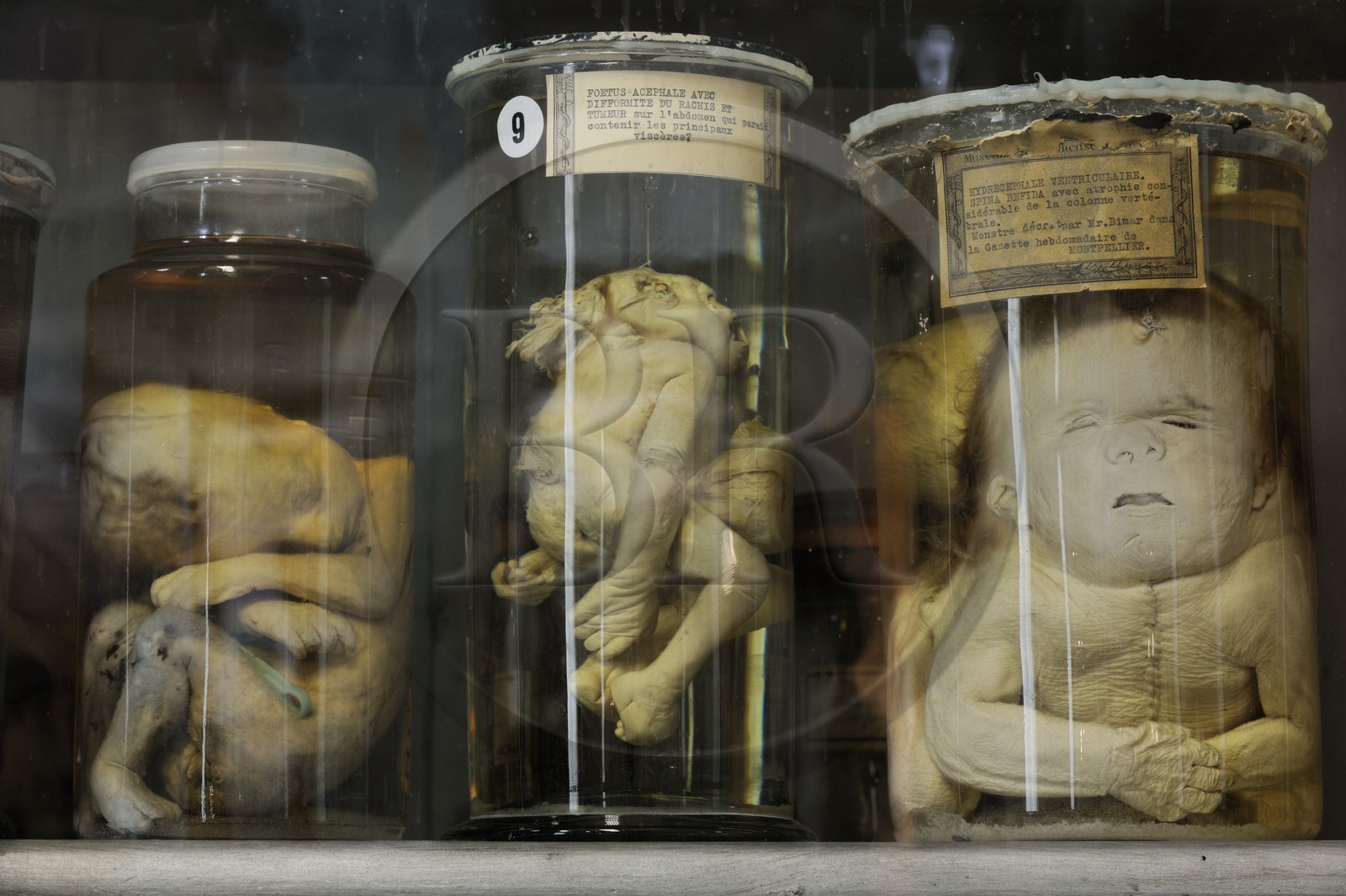 France, Herault, Montpellier, historical center, Medecine University, Anatomy Museum, fetus of the teratology collection which is the scientific study of congenital malformations