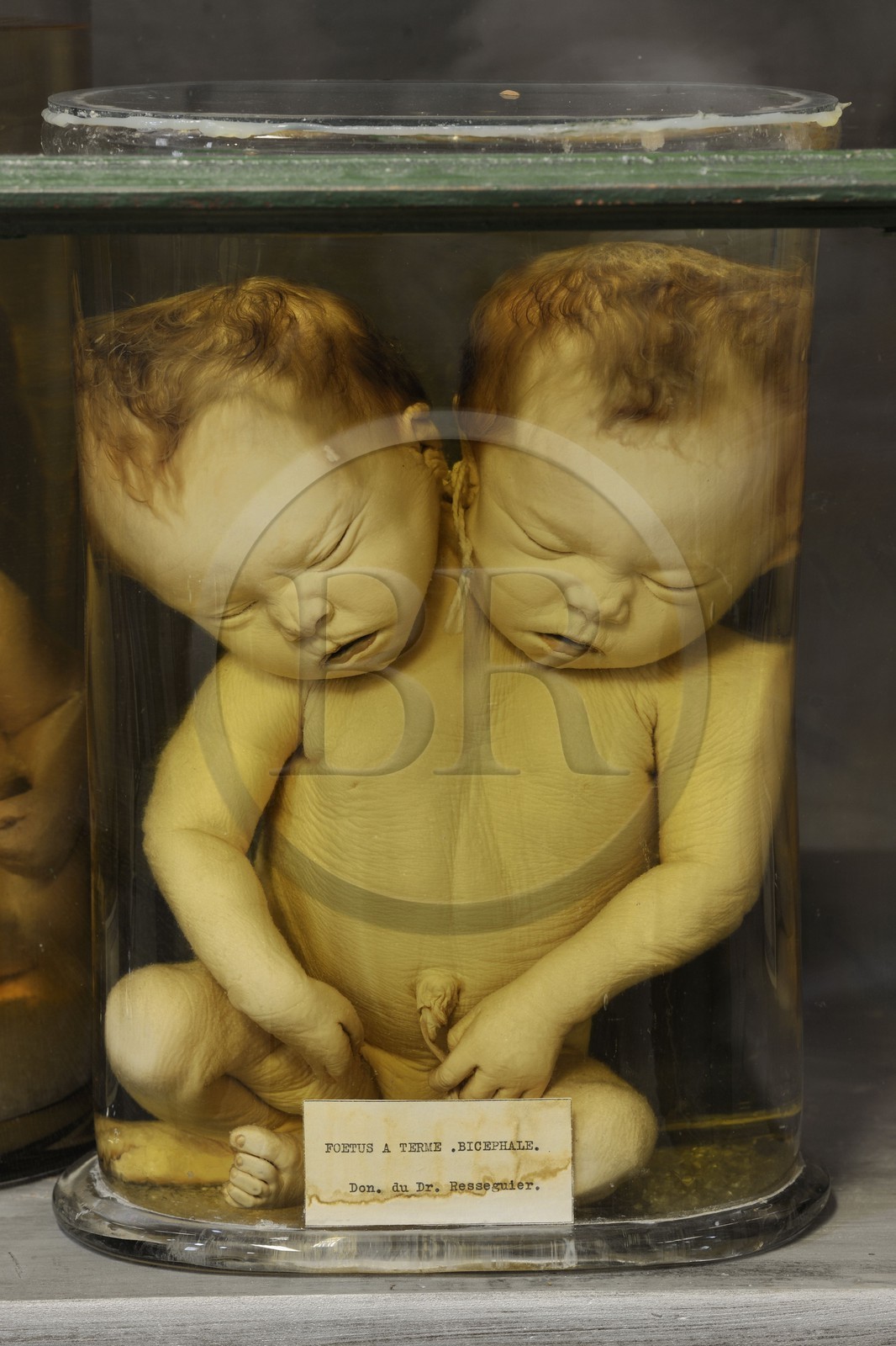 France, Hérault (34), Montpellier, centre historique, faculté de médecine, le musée d'anatomie, foetus de la collection de tératologie qui est l'étude scientifique des malformations congénitales