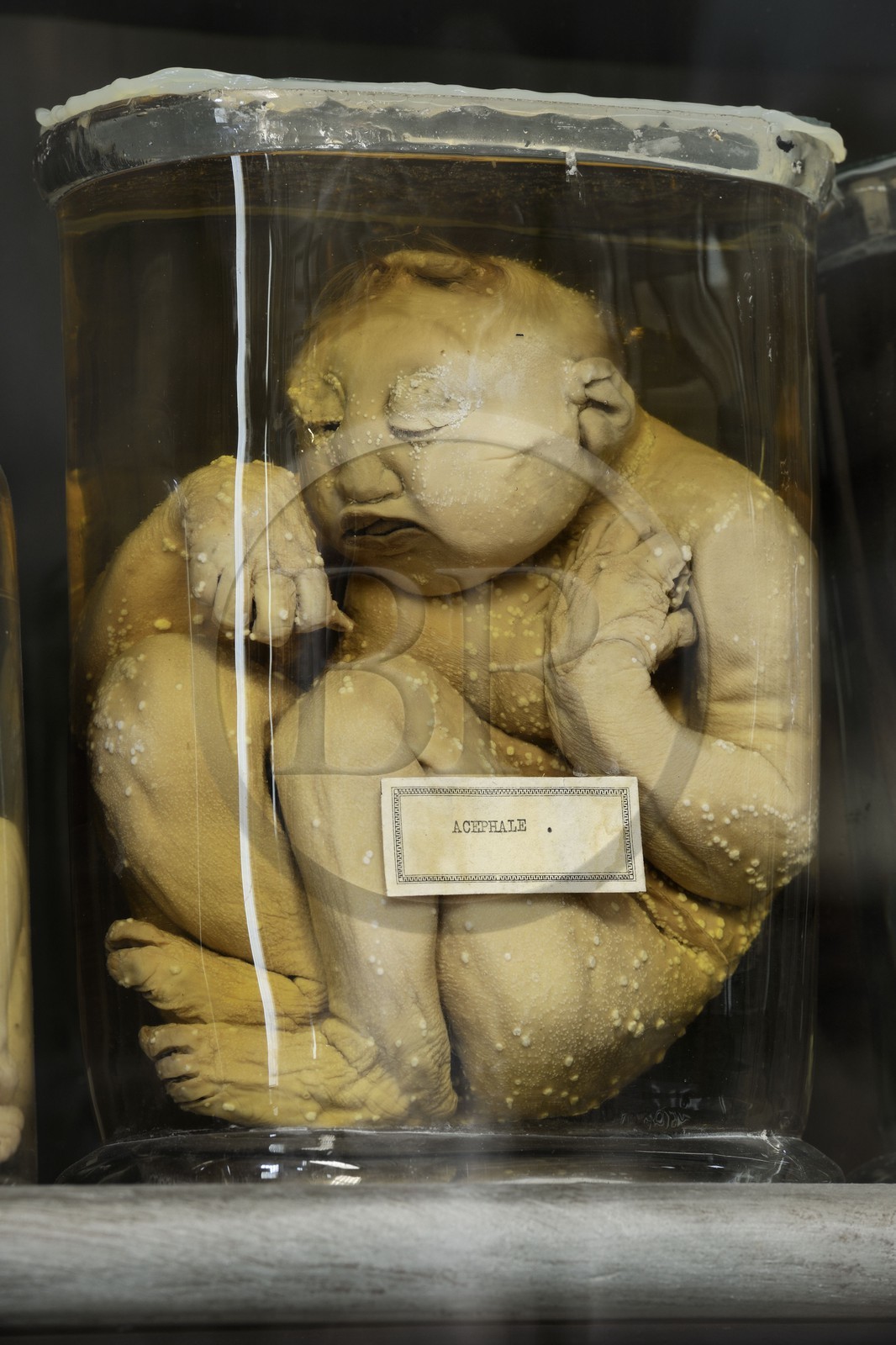 France, Herault, Montpellier, historical center, Medecine University, Anatomy Museum, fetus of the teratology collection which is the scientific study of congenital malformations