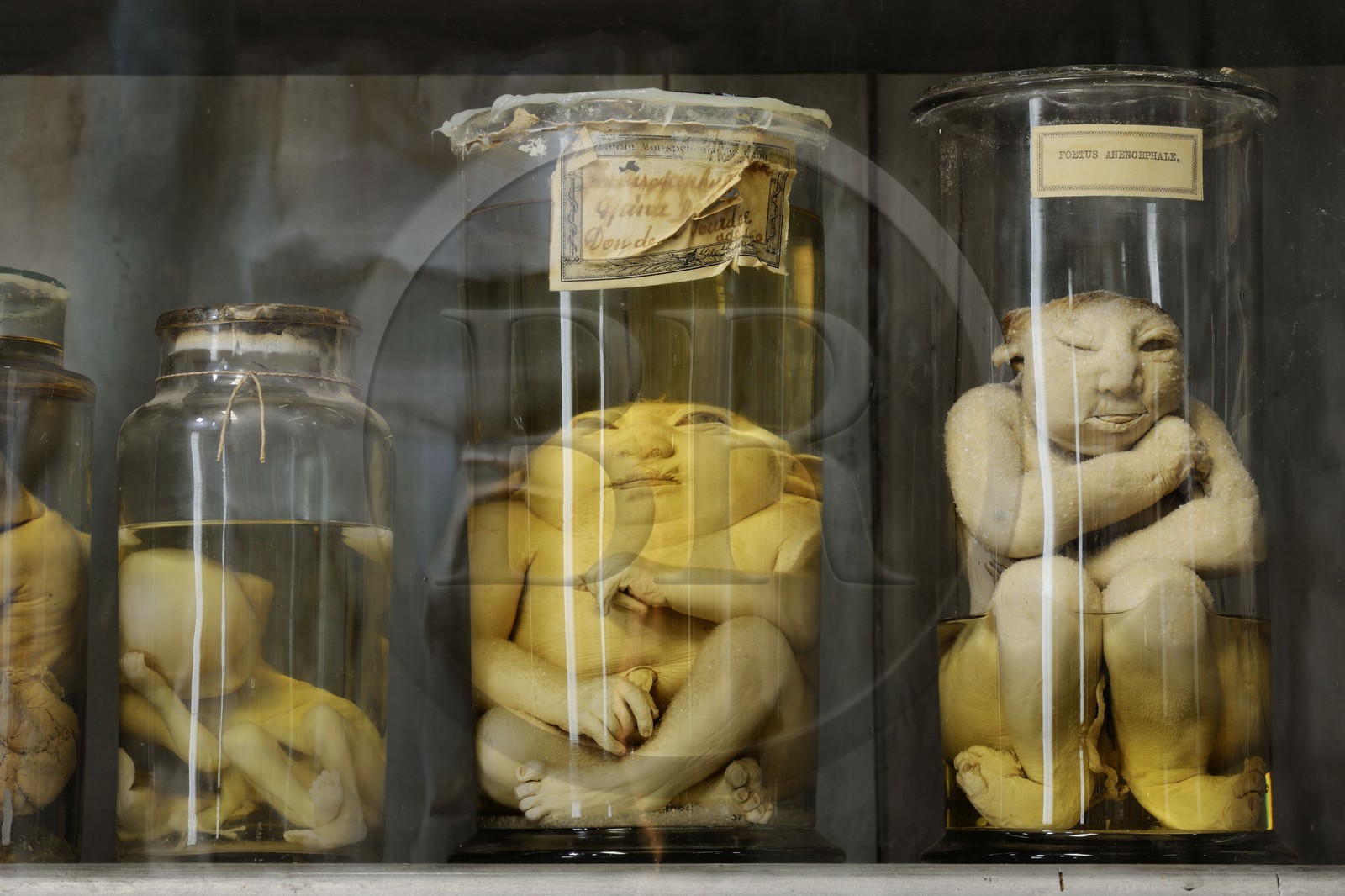 France, Hérault (34), Montpellier, centre historique, faculté de médecine, le musée d'anatomie, foetus de la collection de tératologie qui est l'étude scientifique des malformations congénitales